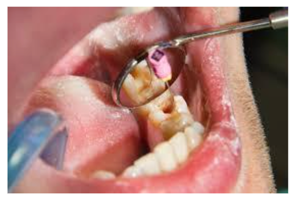 Root Canal Treatment